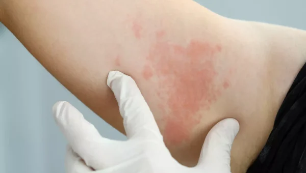 174083-allergy 174083-allergy